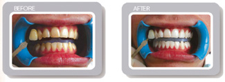 Before-After